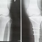 骨折日記14：脛骨高原骨折　術前・術後　チタン入
