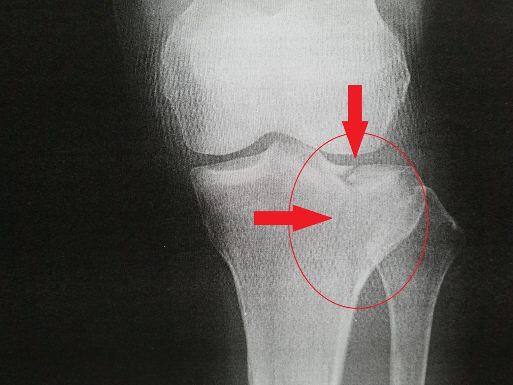 骨折日記14：脛骨高原骨折 術前・術後 チタン入 | michiko